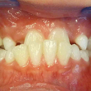 Jane_before_closed_bite