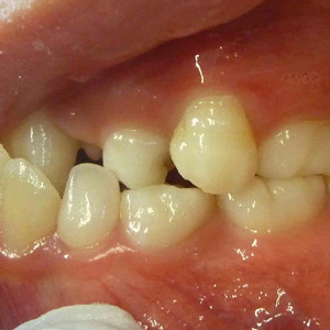 Jane_before_left_bite