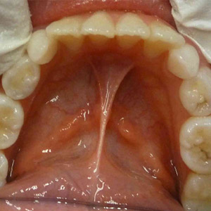 Jane_before_lower_occlusal