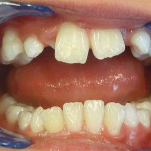 Jane_before_open_bite