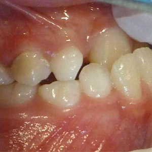 Jane_before_right_bite