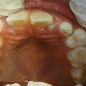 Jane_before_upper_occlusal