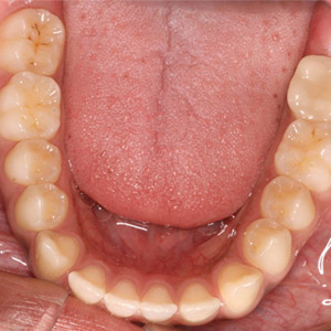 rivan_before_upper_occlusal