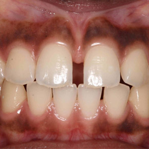 rivan_before_open_bite