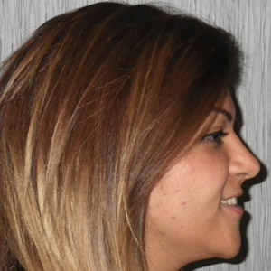 rivan_after_face_side_smile