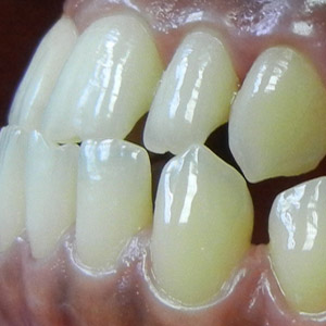 rivan_before_left_bite