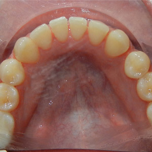 rivan_before_lower_occlusal