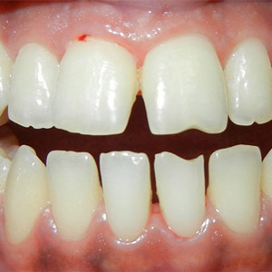 rivan_before_open_bite