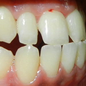 rivan_before_right_bite