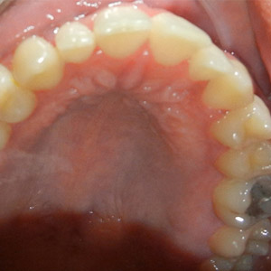 rivan_before_upper_occlusal